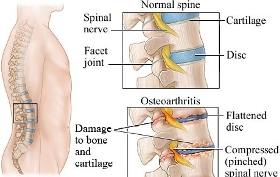 La differenza tra un disco sano e una fetta con osteocondosi