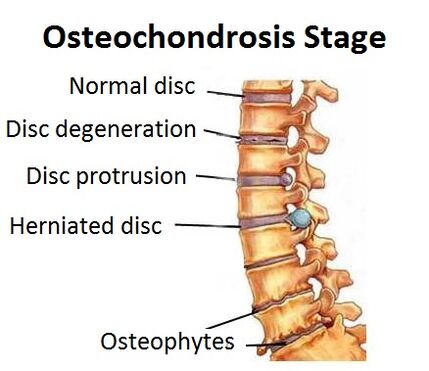 Stadi di osteocondrosi