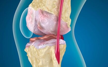 Le ragioni dello sviluppo dell'osteoartrite dell'articolazione del ginocchio